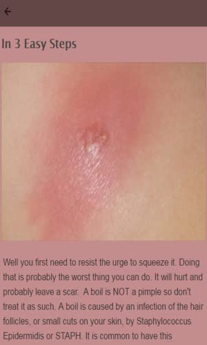 How To Treat A Boil