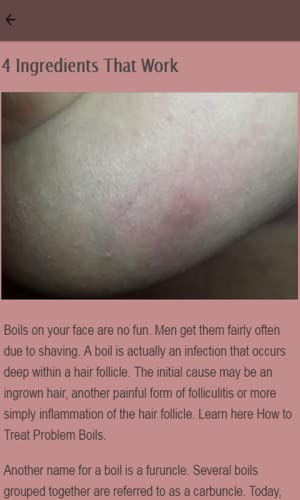 How To Treat A Boil
