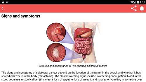 Colon Cancer