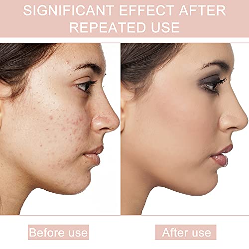 Mecmbj 144 Piezas Parches Acne Hidrocoloide, Invisible Parches Granos Pegatinas de Acné Acné Espinilla Patch Parche Absorbente de Acné para Mujeres