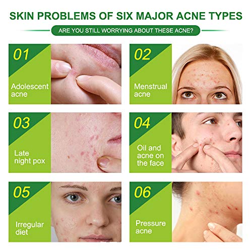 Acne Pimple Patch, Parches de Acné, Pegatinas de Acné, Invisibles Hidrocoloides Absorbentes Parches Para Acné, Tratamientos de Acné, Espinilla y Manchas
