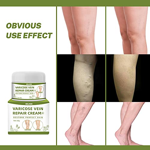 Bakermiche Crema de Varices Crema de reparación de piernas de araña Crema para vasculares Alivio de la angitis por flebitis para Las piernas Crema calmante para Las piernas Circulacion Piernas