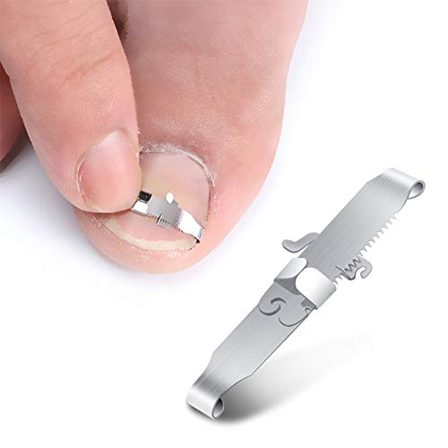 BEZOX 2Pcs Corrección de Uña Encarnada Profesional, hebilla de corrección de uñas encarnadas y elevador de uñas para uñas encarnadas y tratamien