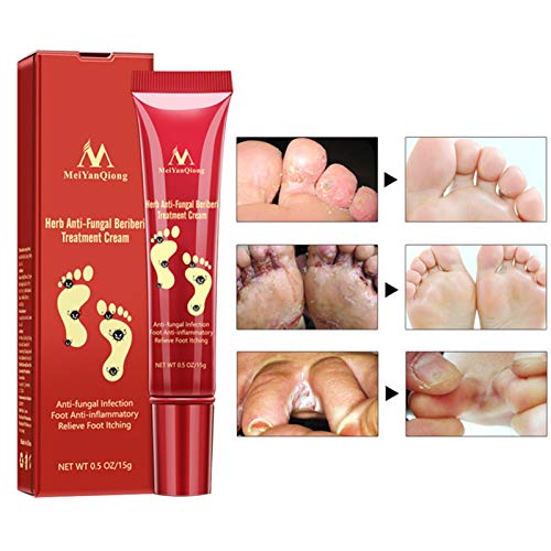 Bulary Herb Antihongos Beriberi Crema de tratamiento Crema para el cuidado de los pies Ampollas Peeling Beriberi Pies pomadas Ungüento