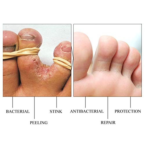 Bulary Herb Antihongos Beriberi Crema de tratamiento Crema para el cuidado de los pies Ampollas Peeling Beriberi Pies pomadas Ungüento