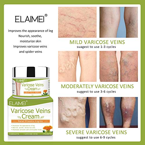 Crema de venas varicosas, tratamiento de venas varicosas, crema de tratamiento de venas de araña para piernas, mejora la circulación sanguínea, piernas cansadas y pesadas alivio rápido
