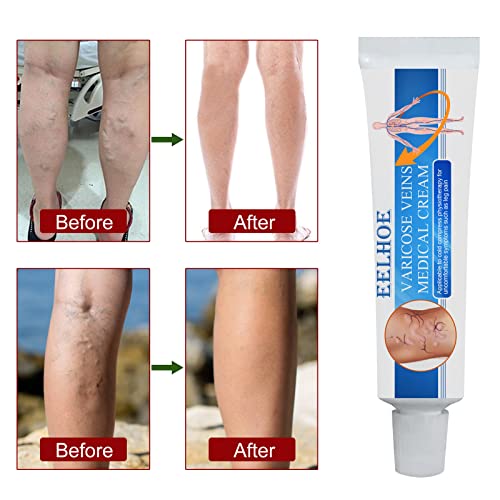 Crema para venas varicosas, crema para el cuidado de la hinchazón de las piernas, crema para reparar las piernas de araña, crema para el tratamiento de las venas varicosas (2PCS)