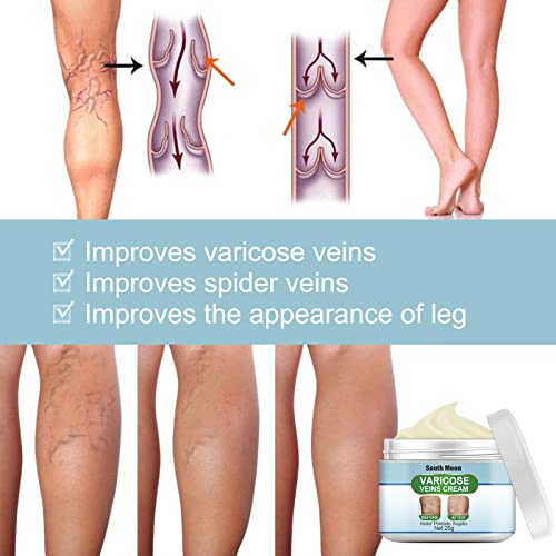 Crema reparadora de venas de araña Beauskin, crema para venas varicosas, crema reparadora de piernas de araña, crema para el tratamiento de venas varicosas, mejora la apariencia de las piernas (3pcs)