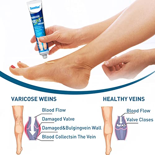 Utapossin Tratamiento De Las Arañas Vasculares, Crema Para Arañas Vasculares En Las Piernas, Crema Para Varices Y Piernas Cansadas E Inflamadas, Cuidado De Piernas Suav (20g)